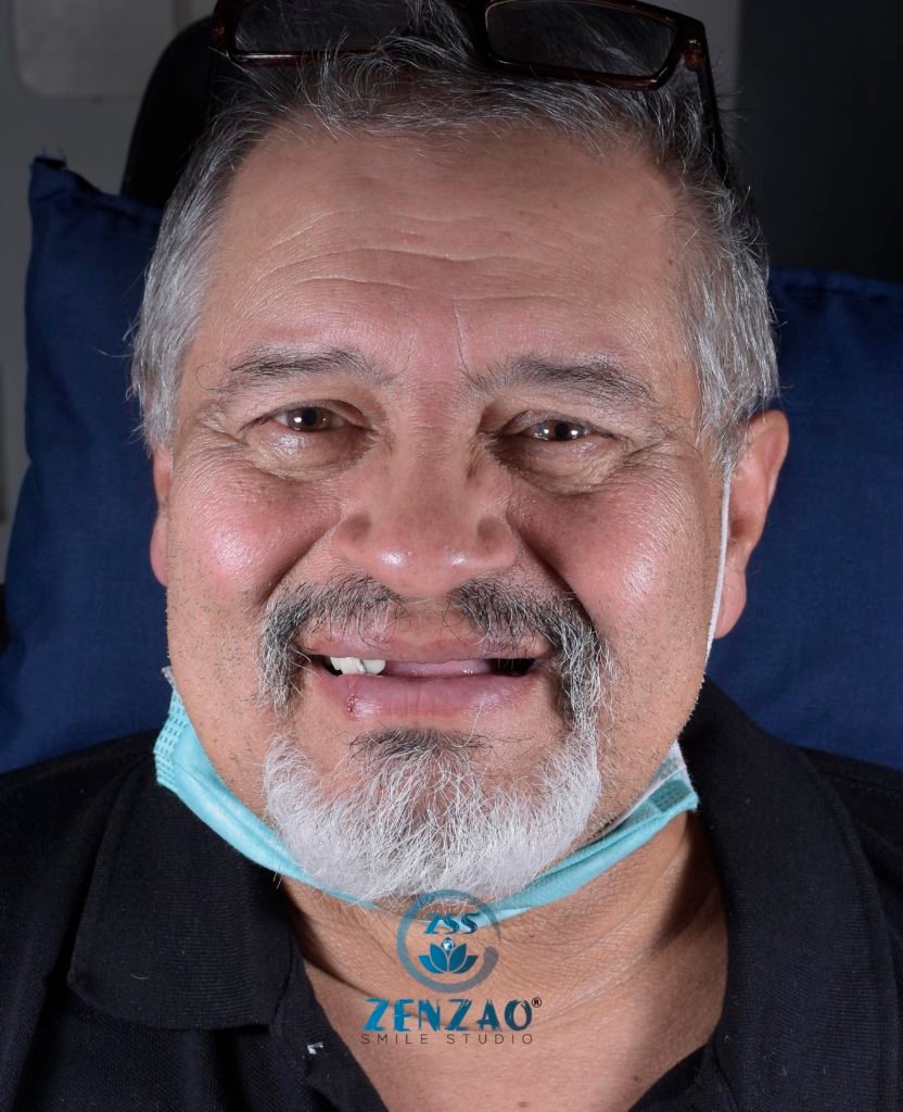 All On 4. Implantes Dentales Superiores e Inferiores