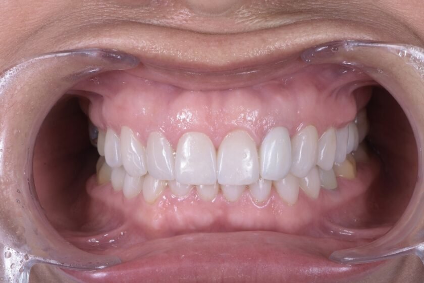 Diseño de Sonrisa