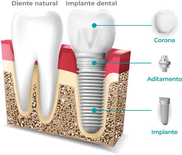 Implante Dental Que Es3