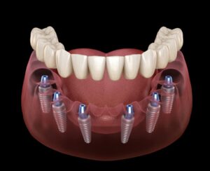 Implantes dentales fijos