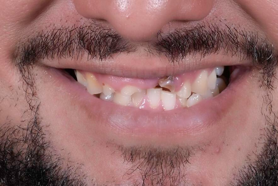 Antes