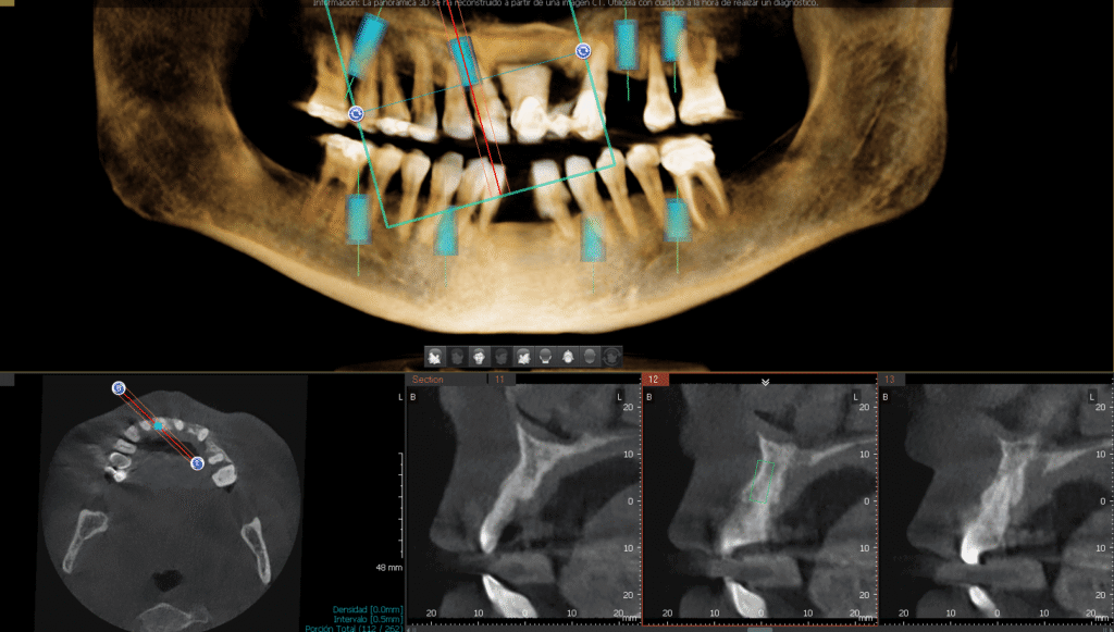 Tomografia Cone Beam para planeación de All On 4