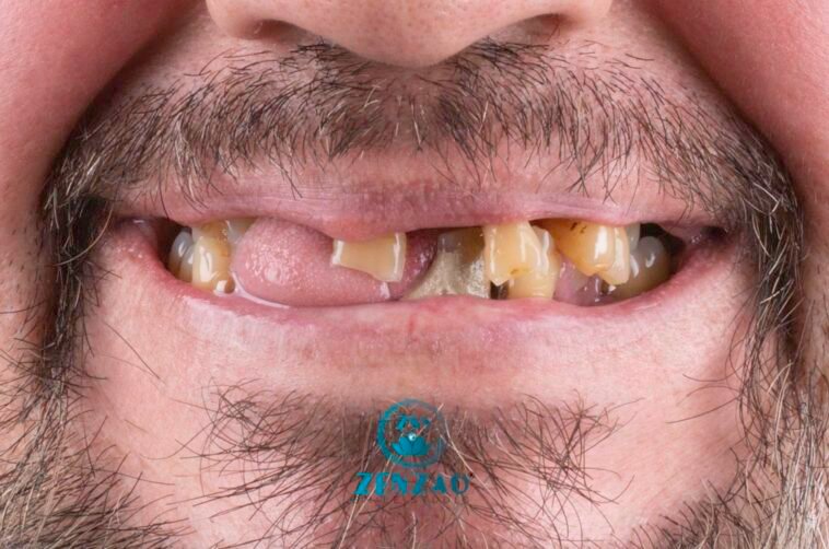 Antes